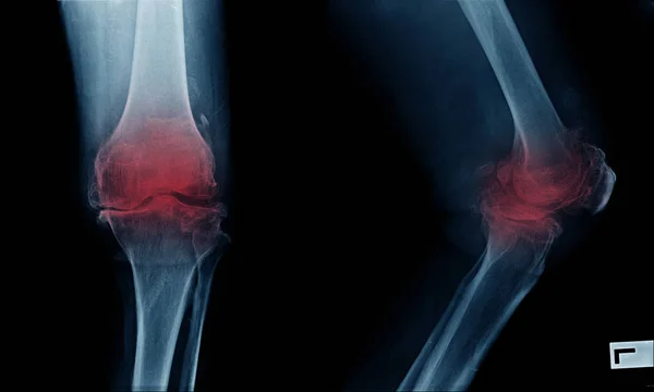 severe OA knee x-ray image on blue color with black background and red color of inflammation area