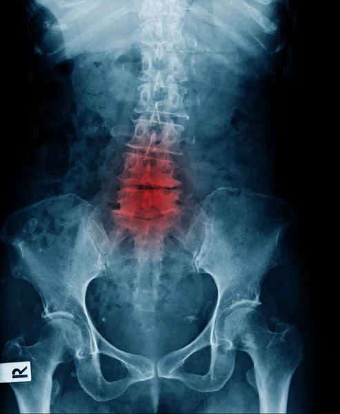 Ray Image Lower Back Show Lumbar Spodylosis Compression Fracture Lumbar — Stock Photo, Image