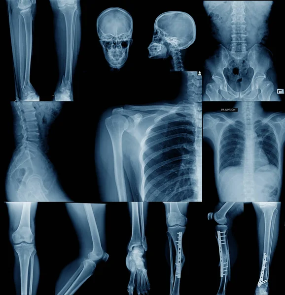 Collection Ray Image Skull Shoulder Hip Knee Joint Scoliosis Spinne — Stock Photo, Image