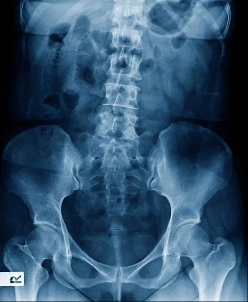 Ray Lumbar Spine Show Degenerative Change Disc Body Spine — Stock Photo, Image