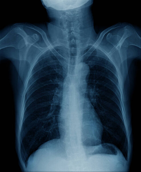 chest x-ray image, high quality of chest xray show secretion of both lung 