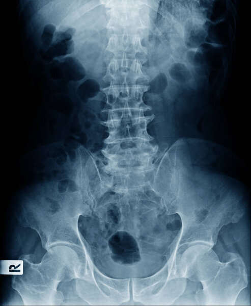 spur and spondylosis or degenerative change of lumbar spine 