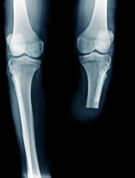 Imagen Rayos Debajo Amputación Rodilla Amputación Bka — Foto de Stock