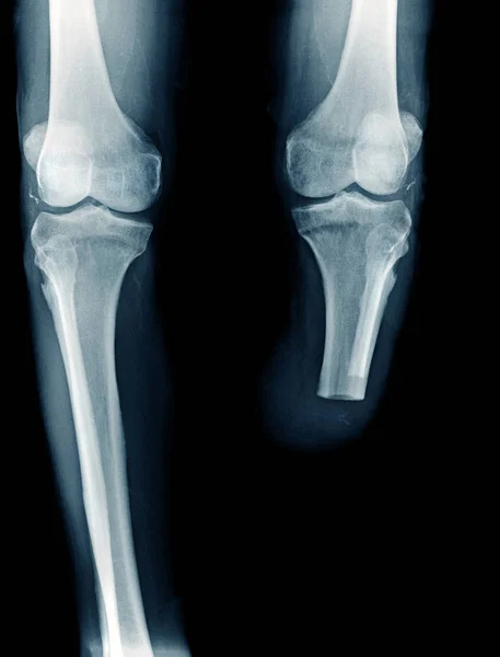 下面的膝盖截肢 线图像 线截肢 Bka 高品质 — 图库照片