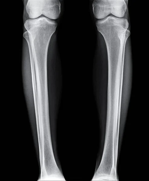 Ray Görüntü Yüksekliği Kalitesi Tibia Fibular Kemik — Stok fotoğraf