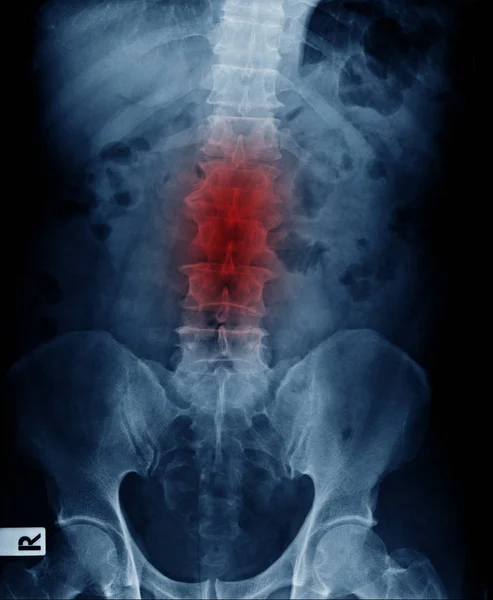 Columna Lumbar Rayos Muestra Cambio Degenerativo Disco Cuerpo Columna Vertebral — Foto de Stock