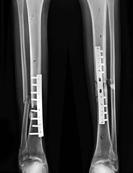 Рентгенівський Зображення Перелом Ноги Післяоперацією Фіксації Великогомілкової Кістки — стокове фото