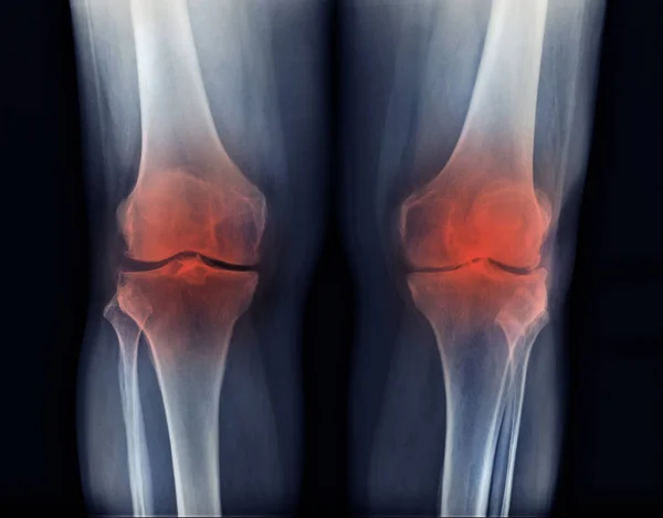 Osteoartritis Imagen Rayos Rodilla Alta Calidad Vista Rodilla — Foto de Stock