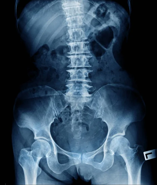 Radiographie Lombaire Montrent Changement Dégénératif Disque Corps Colonne Vertébrale — Photo