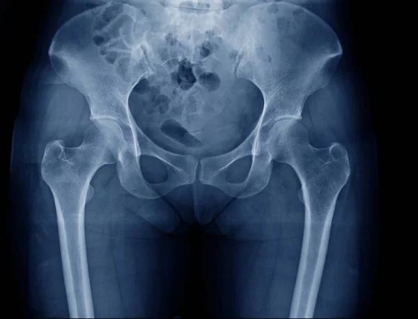 Radiografía Cadera Hueso Pélvico — Foto de Stock