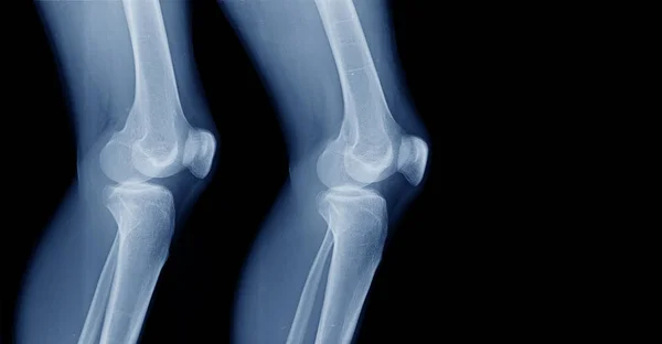 x-ray knee lateral view