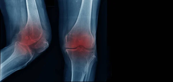 严重膝关节关节炎 膝关节 — 图库照片
