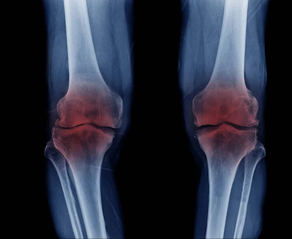 x-ray OA knee frontal view