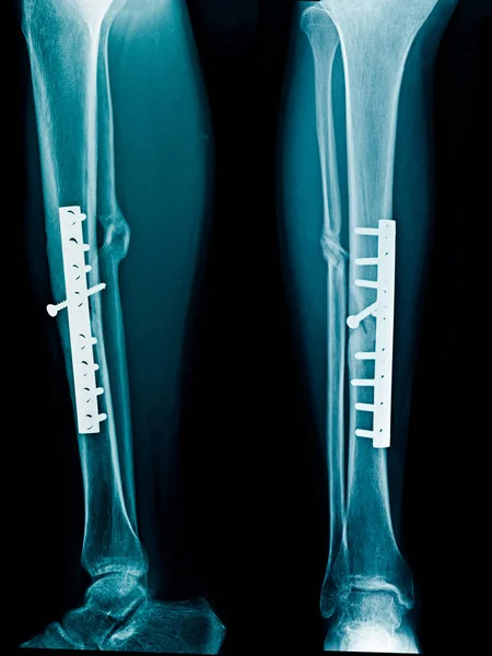 Fixação Tíbia Fratura Radiografia — Fotografia de Stock