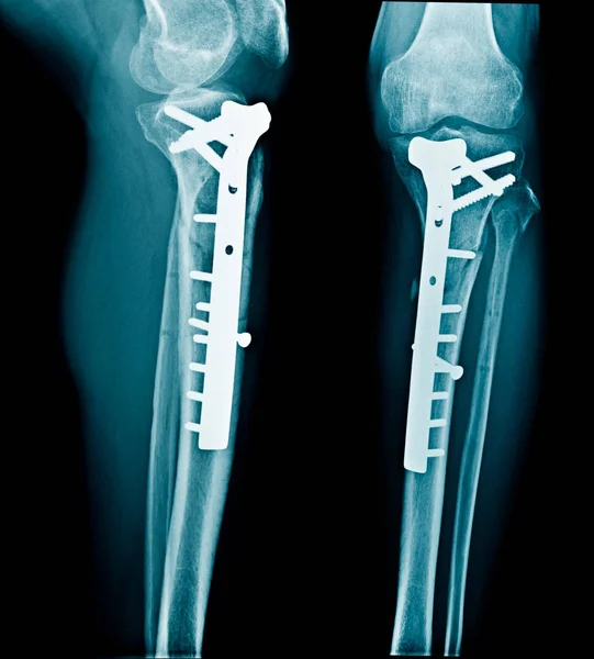 Radiografia Fixação Interna Tíbia Proximal — Fotografia de Stock