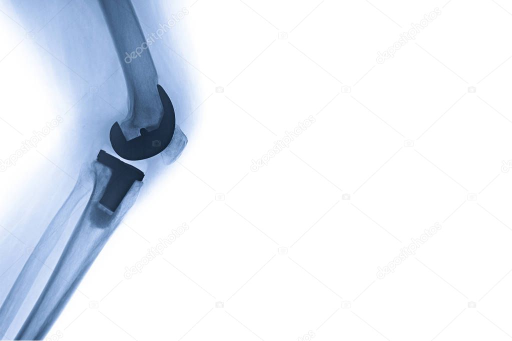 total knee replacement with space for text and banner, website and printing use