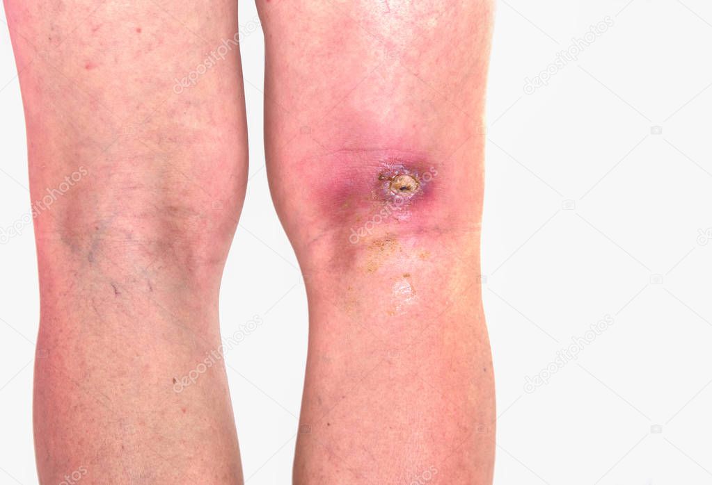 abcess popiteal area, inflammation of popiteal zone at right leg, infected wound righ knee bent
