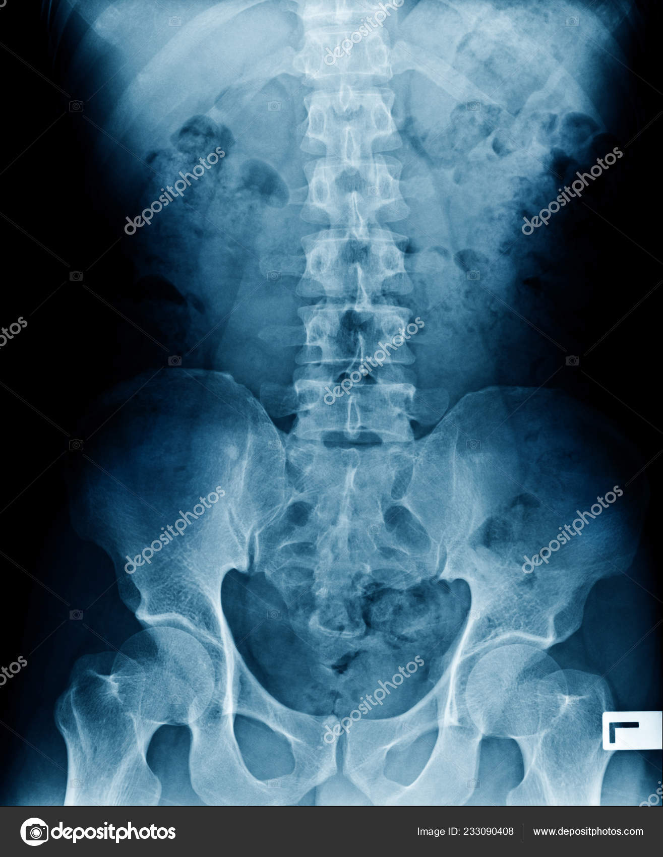 Как делают пояснично крестцовый рентген. Рентген крестцового отдела позвоночника. Рентген поясничного отдела здорового человека. Рентген дорсолюмбального отдела позвоночника. Рентгенография поясничного отдела позвоночника.