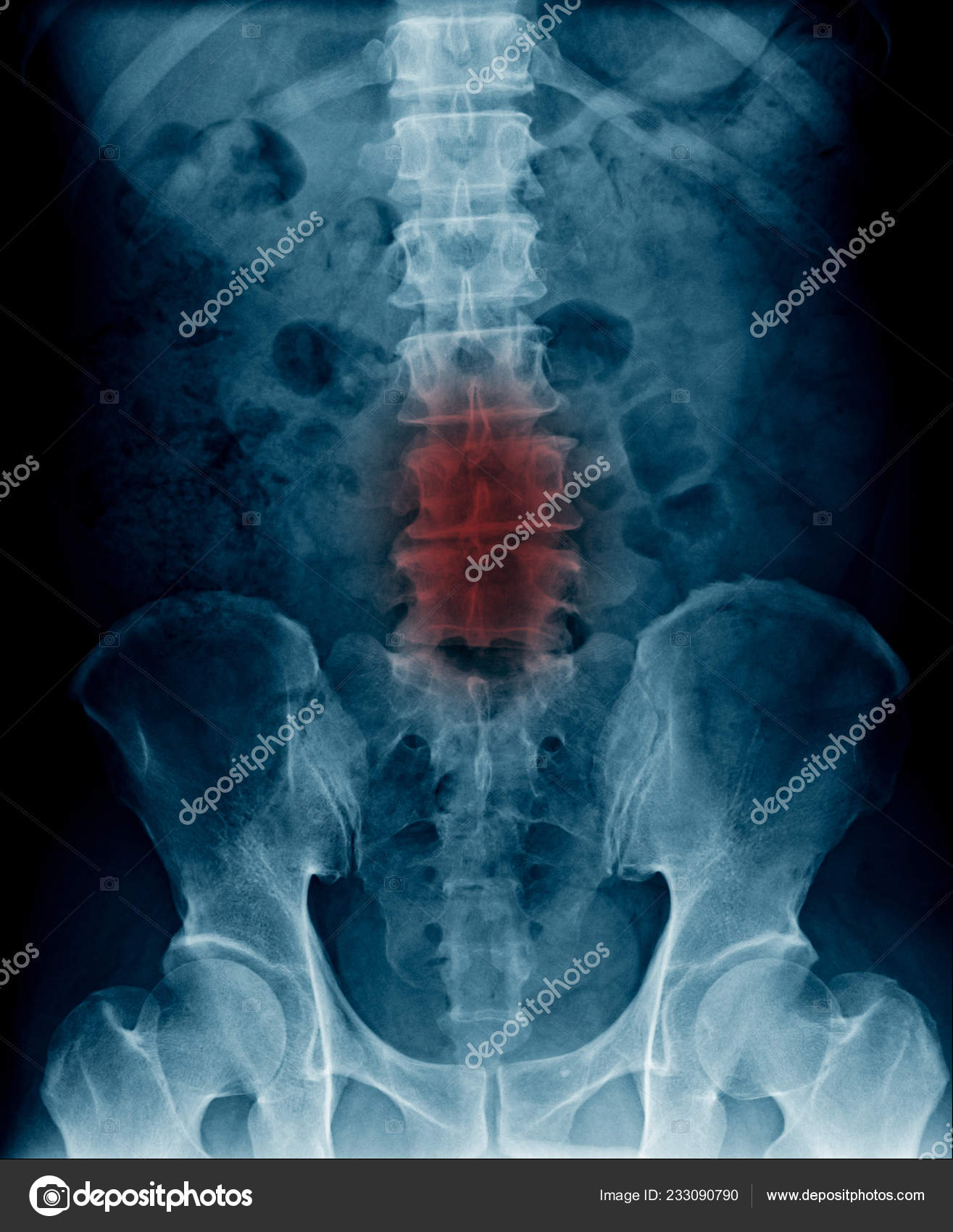 Radiografia Coluna Lombar Estenose Coluna Lombar Espondilose Lombar Raios  Alteração — Foto © Tridsanu #233090790, image size:1315x1700