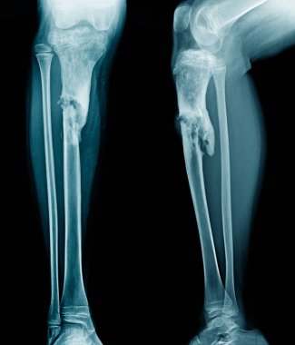 x-ışını bacağı genç kişinin osteomiyelit tibia kemik göster 