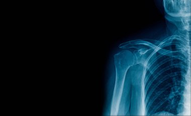 x-ray görüntü omuz tek taraflı, yüksek kaliteli x-ray omuz afiş veya metin için yer 