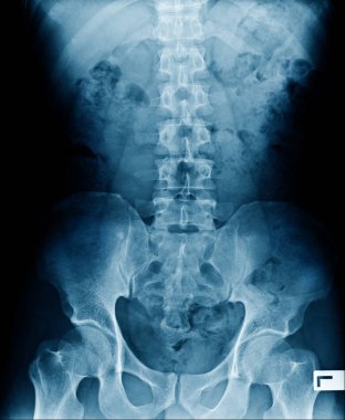 yüksek kaliteli x-ray insan omurga lomber dejeneratif değişim ve torasik omurga ve leğen kemiği hafif spondiloz göster 