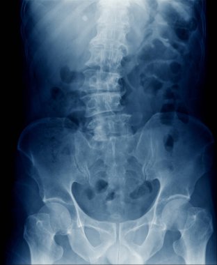 şiddetli skolyoz lomber omurga, yüksek kaliteli x-ray insan omurga göstermek lomber dejeneratif değişim ve hafif spondiloz torasik omurga ve leğen kemiği 