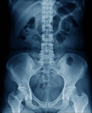yüksek kaliteli x-ray insan omurga lomber dejeneratif değişim ve torasik omurga ve leğen kemiği hafif spondiloz göster 