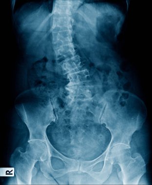 şiddetli skolyoz lomber omurga, yüksek kaliteli x-ray insan omurga göstermek lomber dejeneratif değişim ve hafif spondiloz torasik omurga ve leğen kemiği 