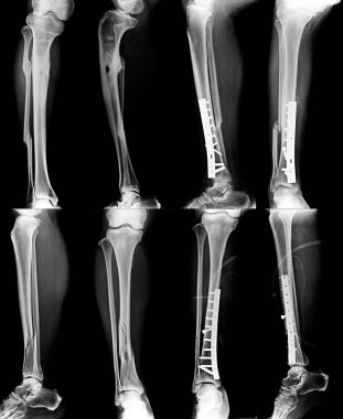 bacak x-ray kırık ve içerik gri tonu ile sabit 