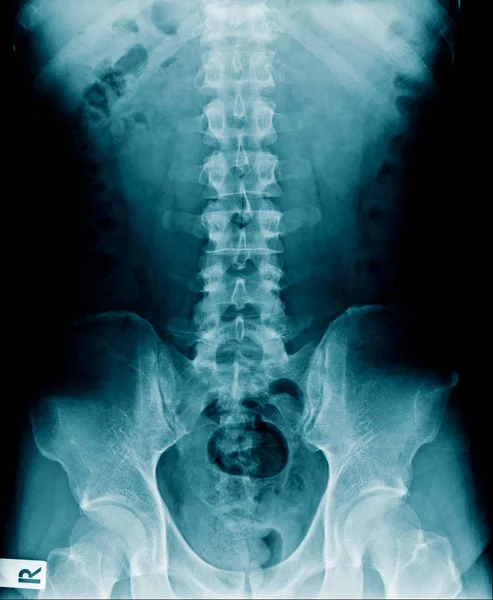 Radiografia Alta Qualidade Coluna Vertebral Humana Mostra Alteração Degenerativa Coluna — Fotografia de Stock