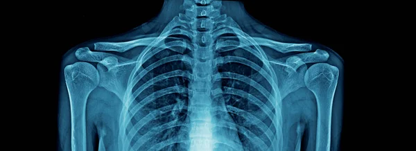 Insan Vücudu Ray Yüksek Kaliteli Göğüs Röntgeni Omurga Tam Bir — Stok fotoğraf