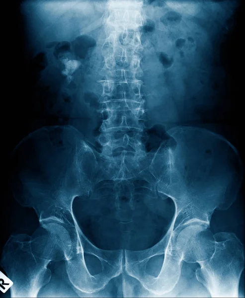 High Quality Ray Human Spine Show Degenerative Change Lumbar Spine — Stock Photo, Image