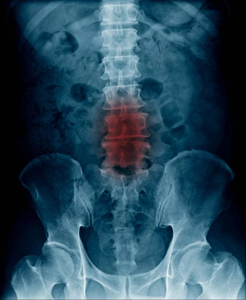 x-ray image of lumbar spine and stenosis of lumbar spine, x-ray lumbar spondylosis and degenertive change of human spine.