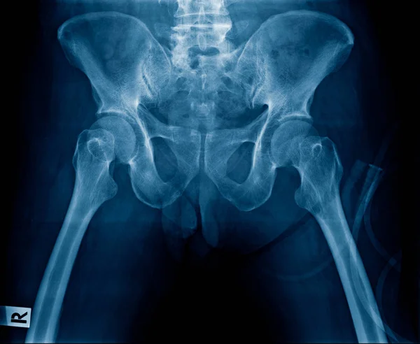 Hip Joint Pain Deformity Hip Joint Both Side — Stock Photo, Image