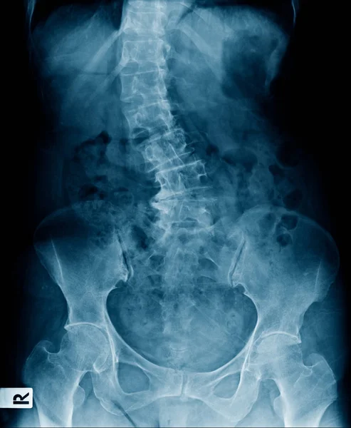 Severe Scoliosis Lumbar Spine High Quality Ray Human Spine Show — Stock Photo, Image