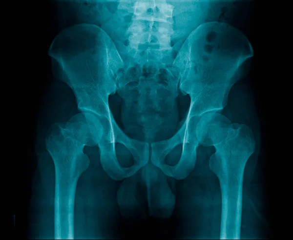 Cambio Degenerativo Articulación Cadera Dolor Del Hombre Viejo Articulación Cadera — Foto de Stock