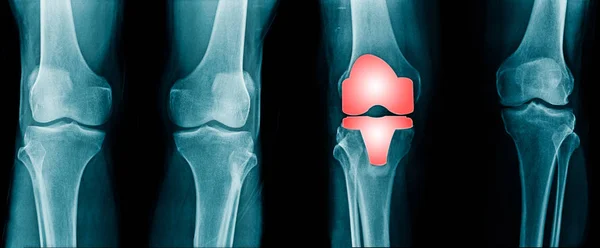 Ray Image Total Knee Artroplasty Blue Tone — Stock Photo, Image