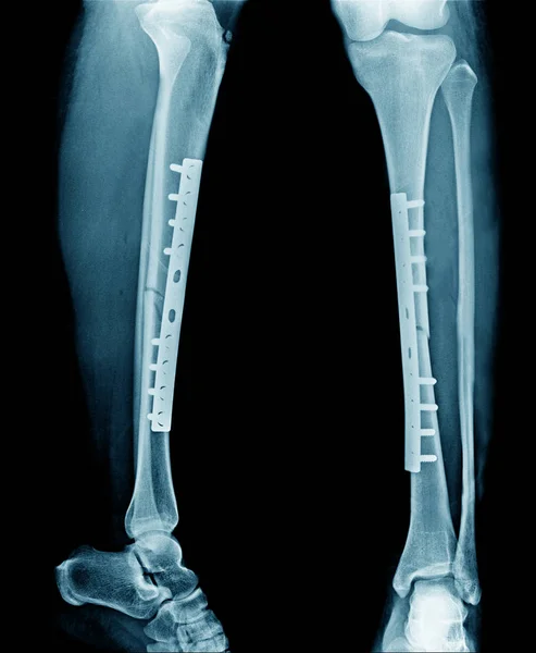 Рентгенівський Перелом Ноги — стокове фото