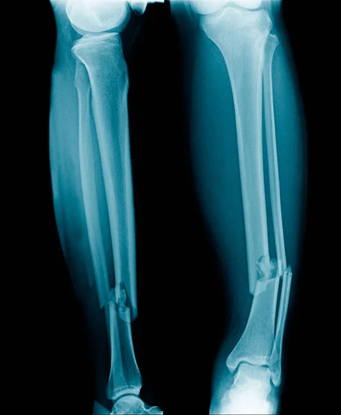 Рентгенівська Переломом Ноги — стокове фото