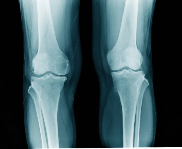 Ray Knee Arthritis — Stock Photo, Image