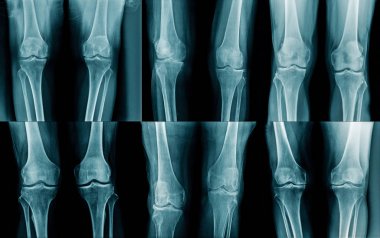 collection x-ray OA knee  clipart