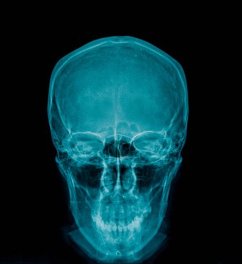 Kafatası x-ray görüntü 