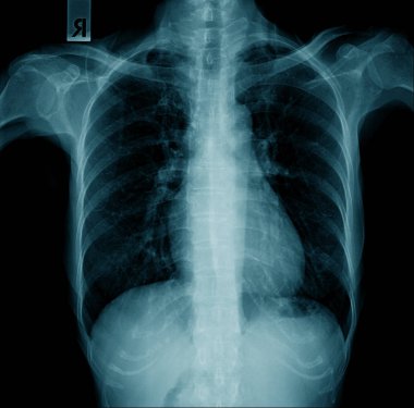 Göğüs x-ray görüntü, yüksek kaliteli x-ray görüntü 