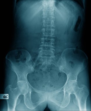 Hight kalite x-ray lomber mavi tonda, xrau görüntü eski dostum Haritayı spondiloz veya omurga ve bölümü og kalça ve leğen kemiği dejenerasyonu 