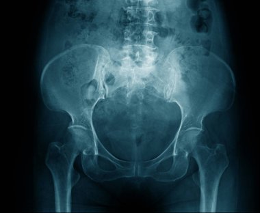 XRAY leğen kemiği, yüksek kaliteli x-ray pelvis mavi ses tonuyla 
