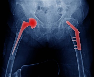 yüksek kaliteli x-ray kalça protezi yaşlı adam, dejeneratif kalça değiştirmek ve post işlemi uyluk kemiği kafa fiksasyon, iki taraflı kalça protezi ve uyluk Başkanı fiksasyonu