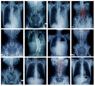 büyük koleksiyon geri ve Pelvis röntgeni, yüksek kaliteli kulanıyorsun x-ray 
