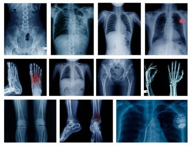 Yüksek kaliteli koleksiyonu x-ray görüntü göstermek insan birçok gövde bölümü