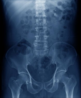 x-ray görüntü spondiloz insan omurga ve leğen kemiği mavi ses tonuyla 